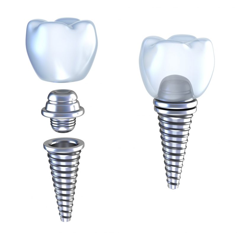 3 Benefits of Dental Implants in Bucks County