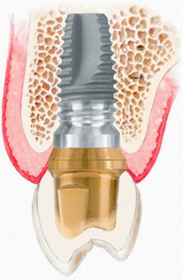 Why Think About Dental Implants