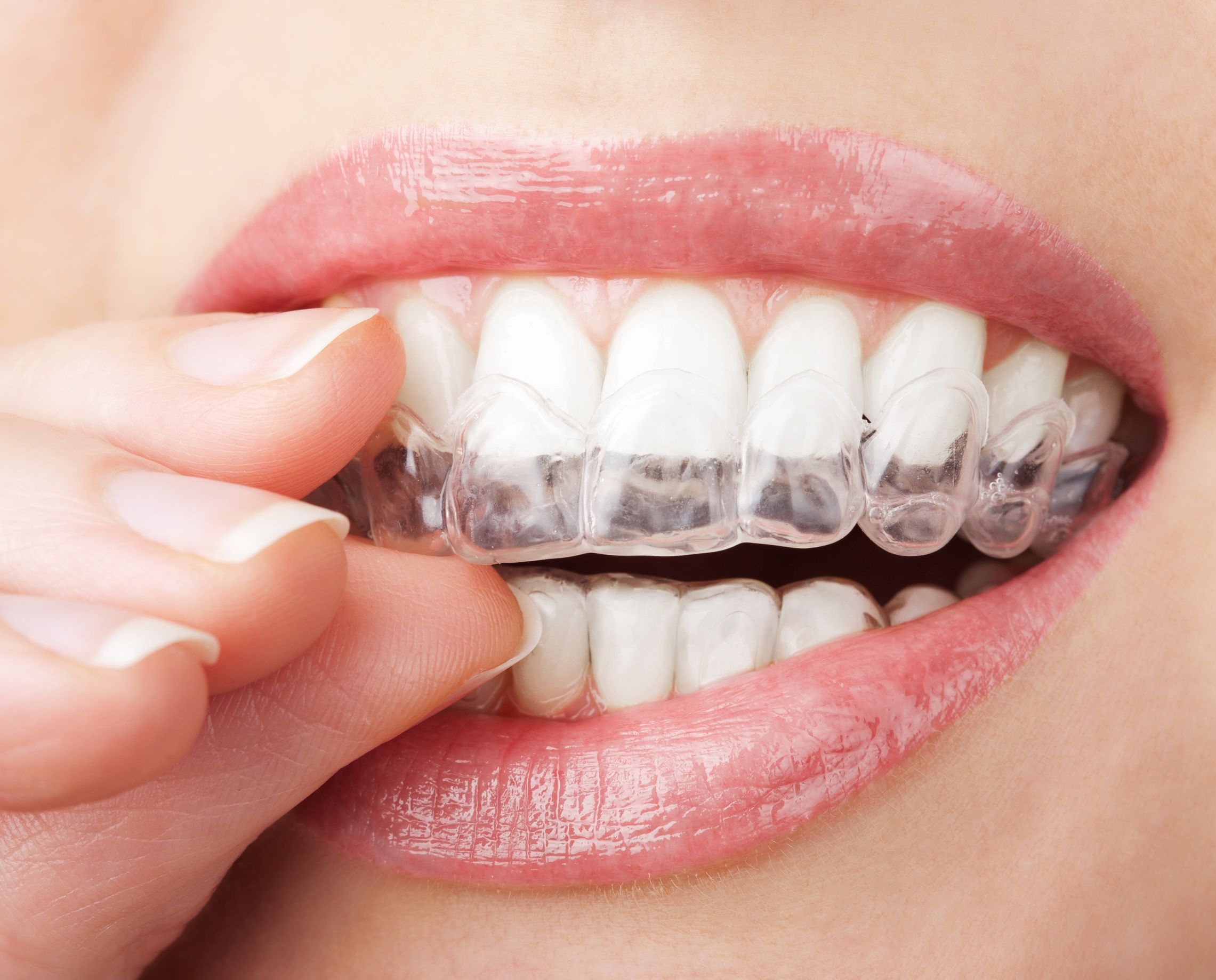 Pros of Getting Clear Aligners in Oxnard, CA