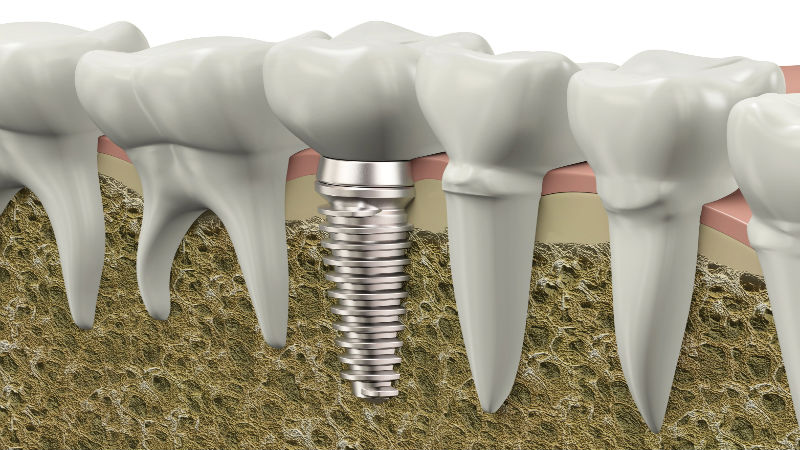 The Top Four Benefits of Dental Implants