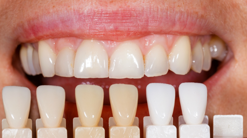 Teeth Whitening: The Secret to a Brighter Smile in Charleston SC