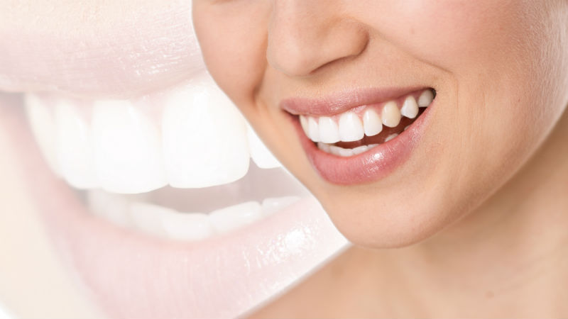 Is All on 4 Dental Implants in Macon, GA the Best Option for You?