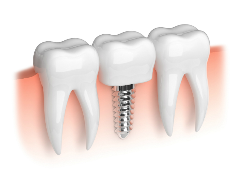 Ask Your Dentist About Dental Implants in Charleston SC