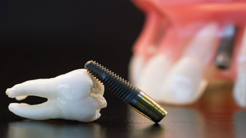 Discovering the Magic of Implant Supported Dentures